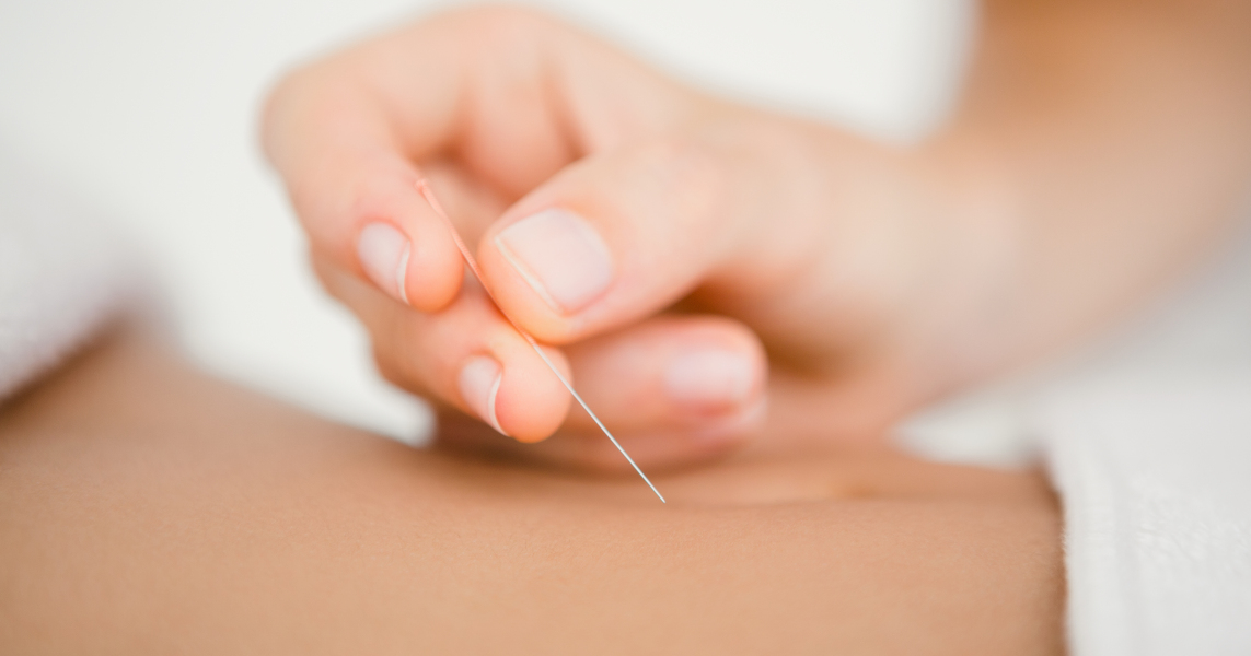 Akupunktur